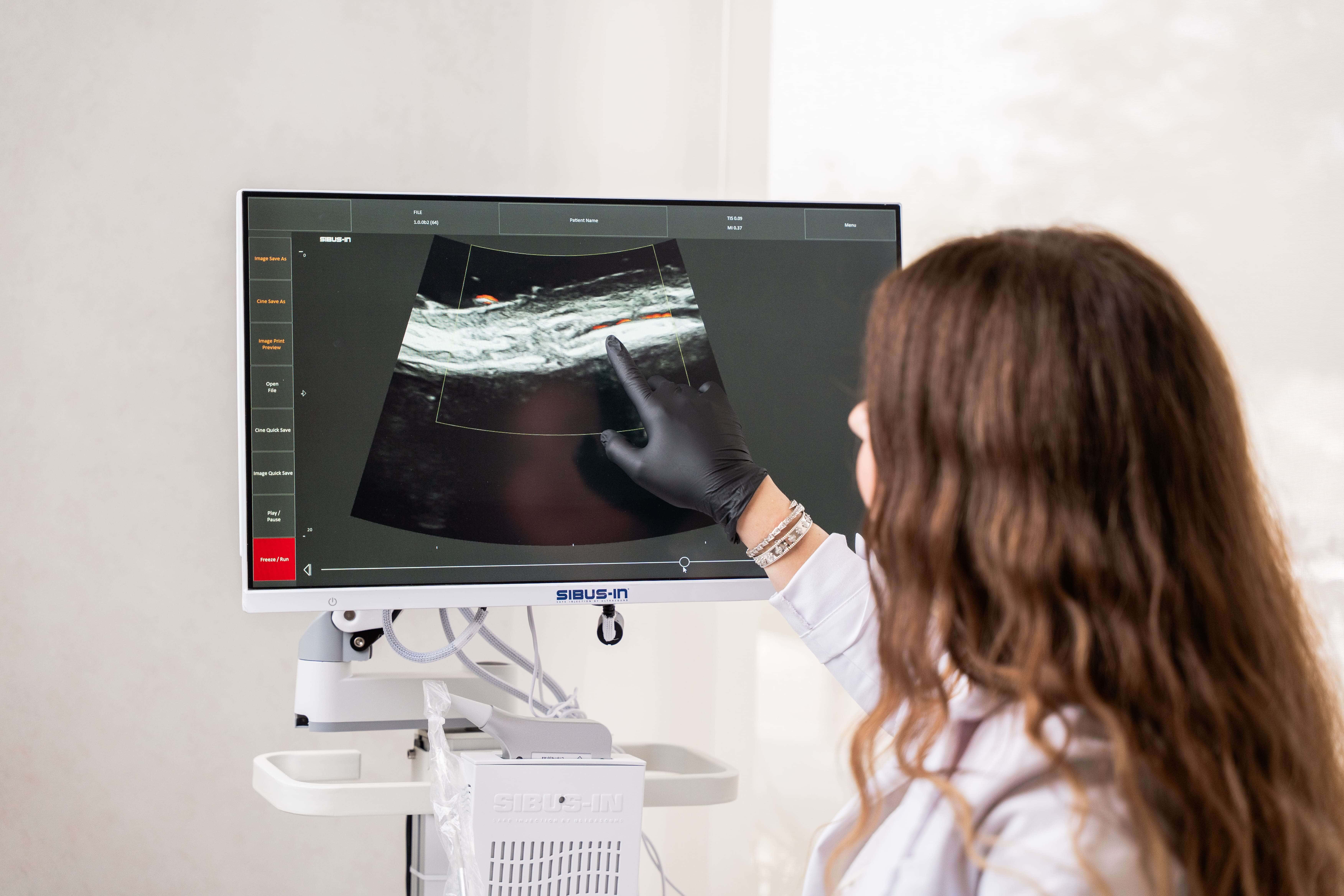 sibus in machine for ultrasound filler guided dissolving