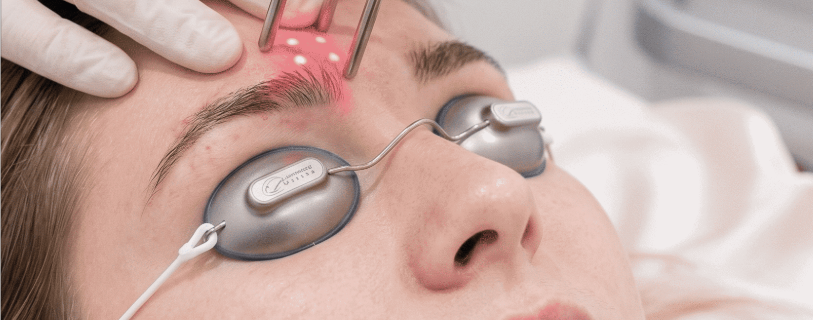 Best Lasers for Eyebrow Tattoo Removal