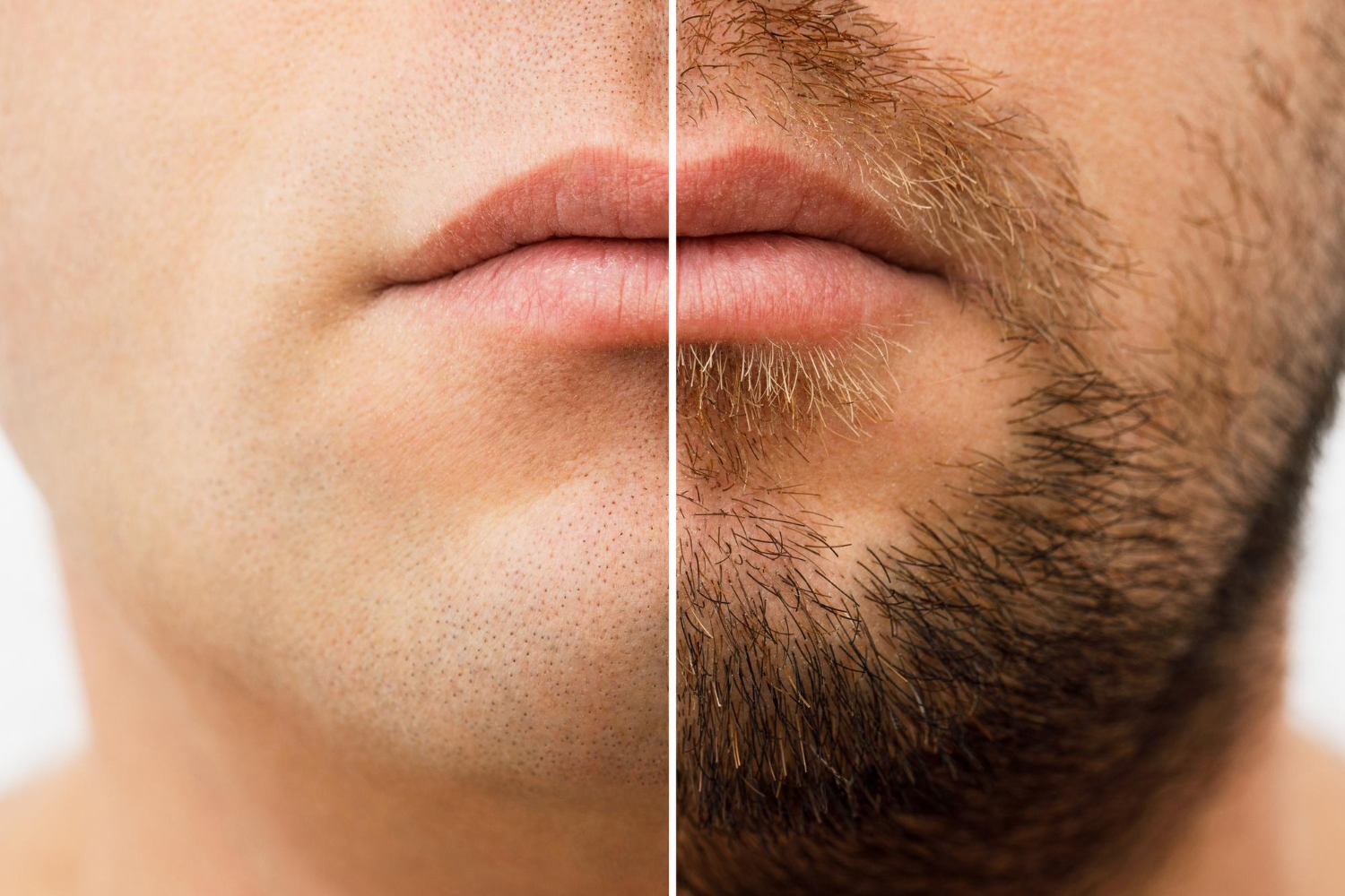 Beard Transplant Dubai Procedure, Recovery And Natural Results