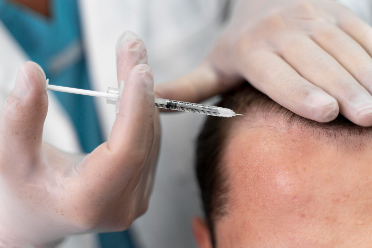 How To Prepare For PRP Hair Loss Treatment A Step-by-step Guide