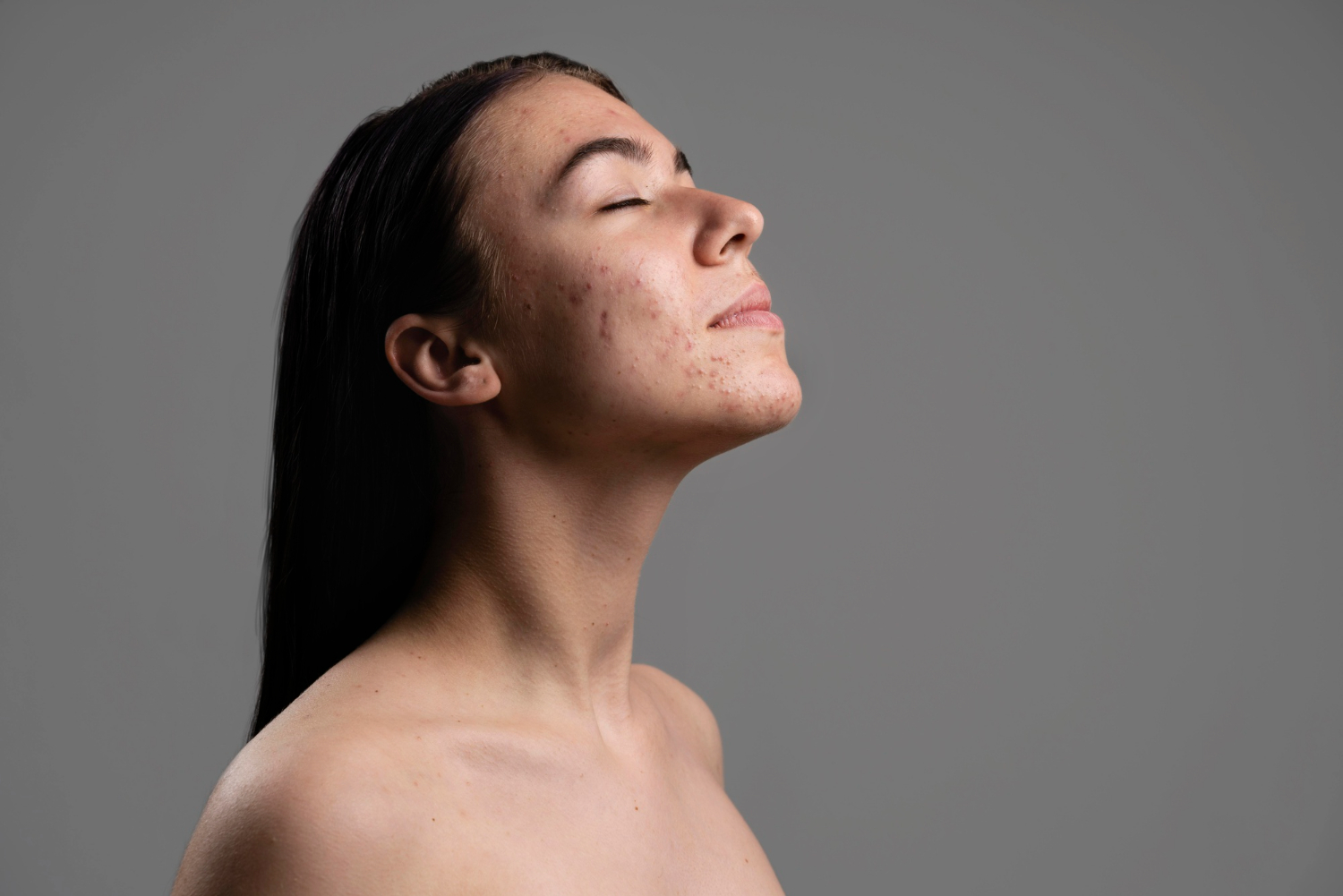 Acne Understanding And Treating This Common Skin Condition