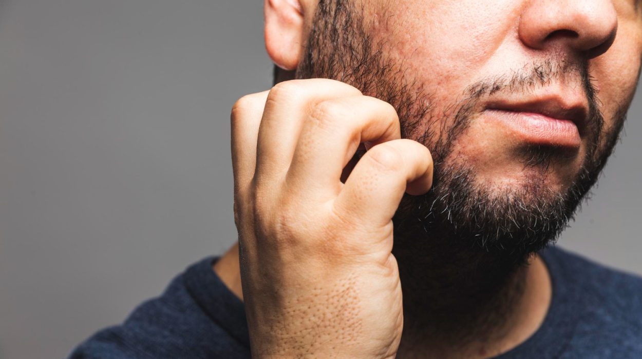 From Patchy To Perfect The Simple Guide To Beard Transplant