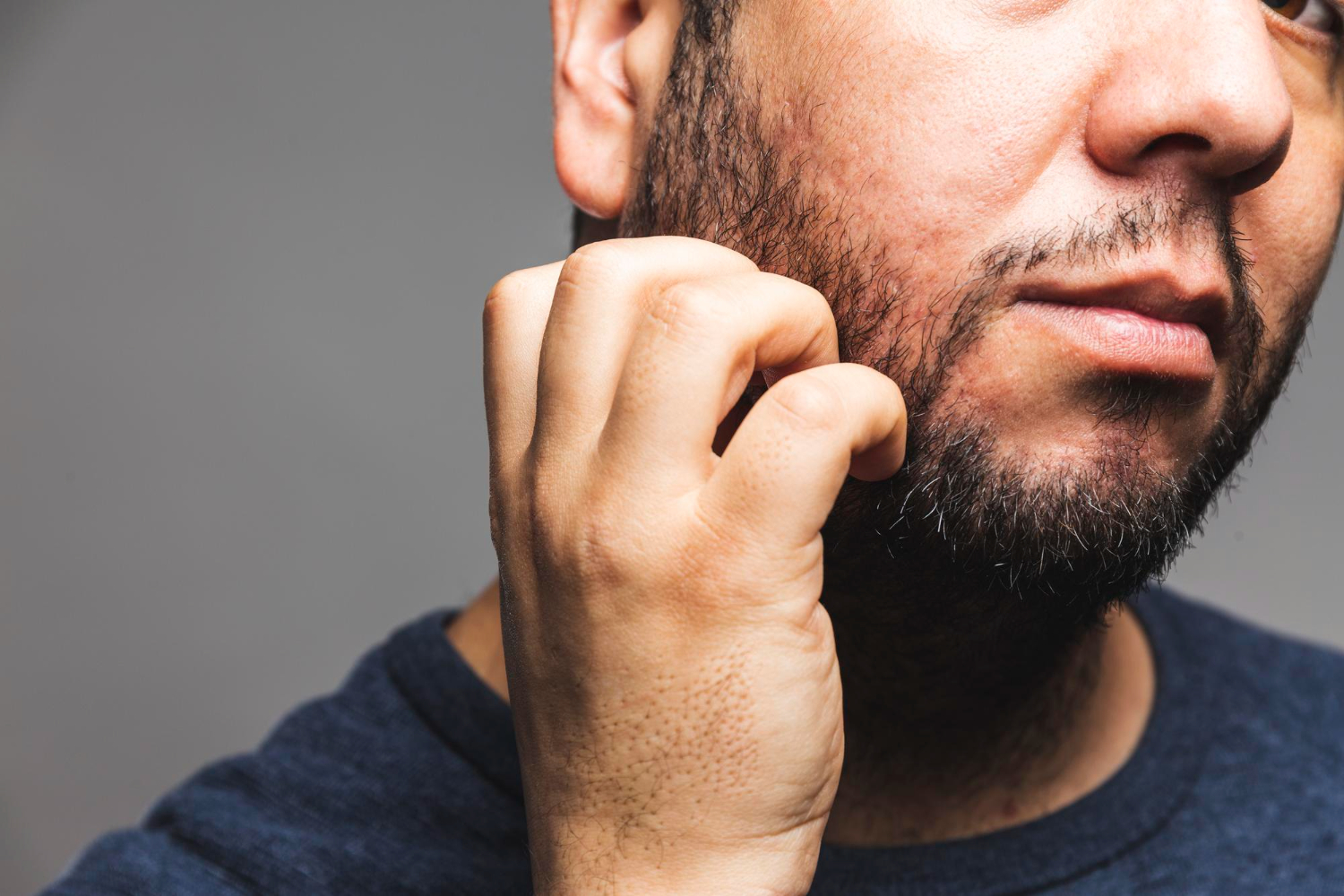From Patchy To Perfect The Simple Guide To Beard Transplant