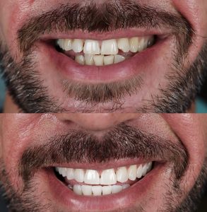 Invisalign