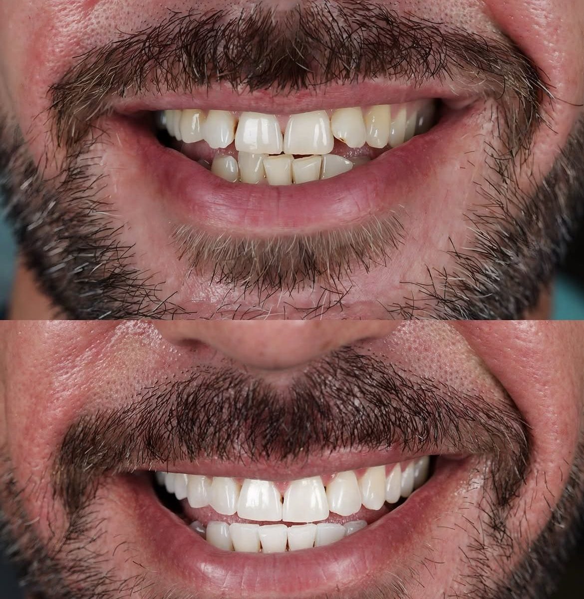 Invisalign