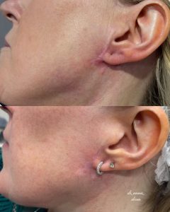 Laser scar resurfacing