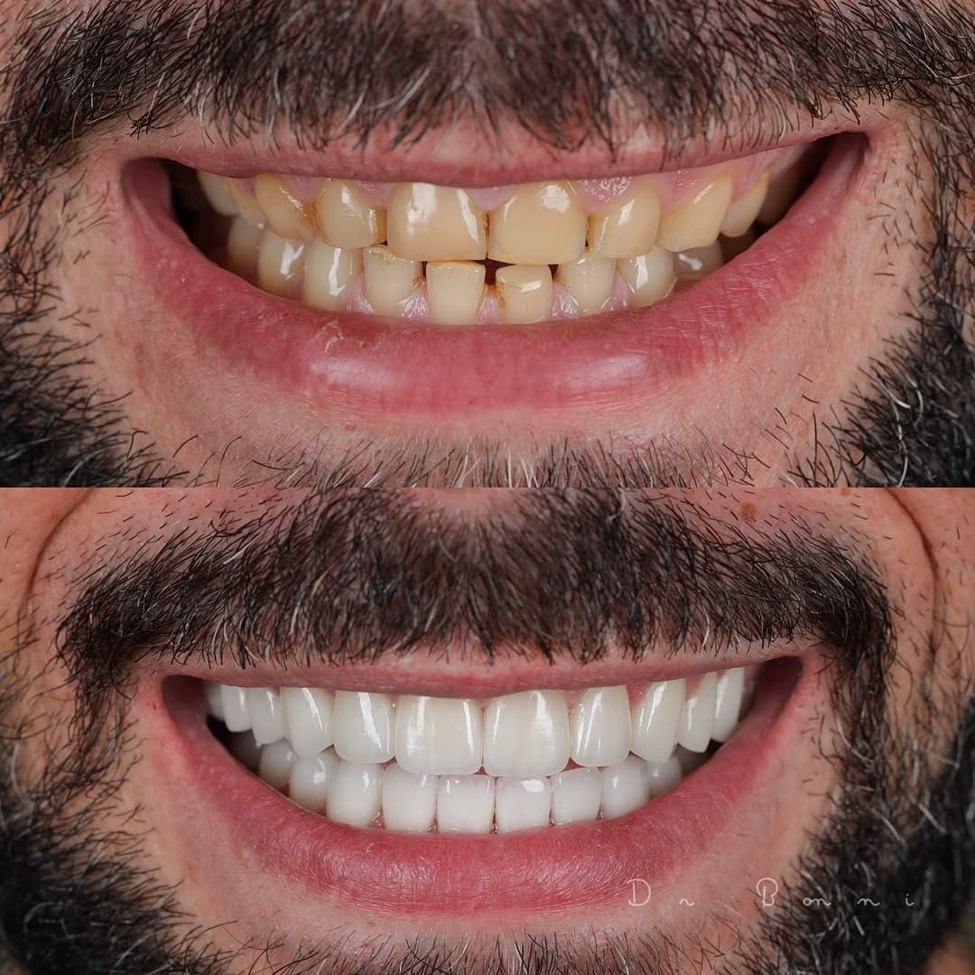 Dental Veneer Before and after