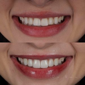 Dental Veneer Before and after