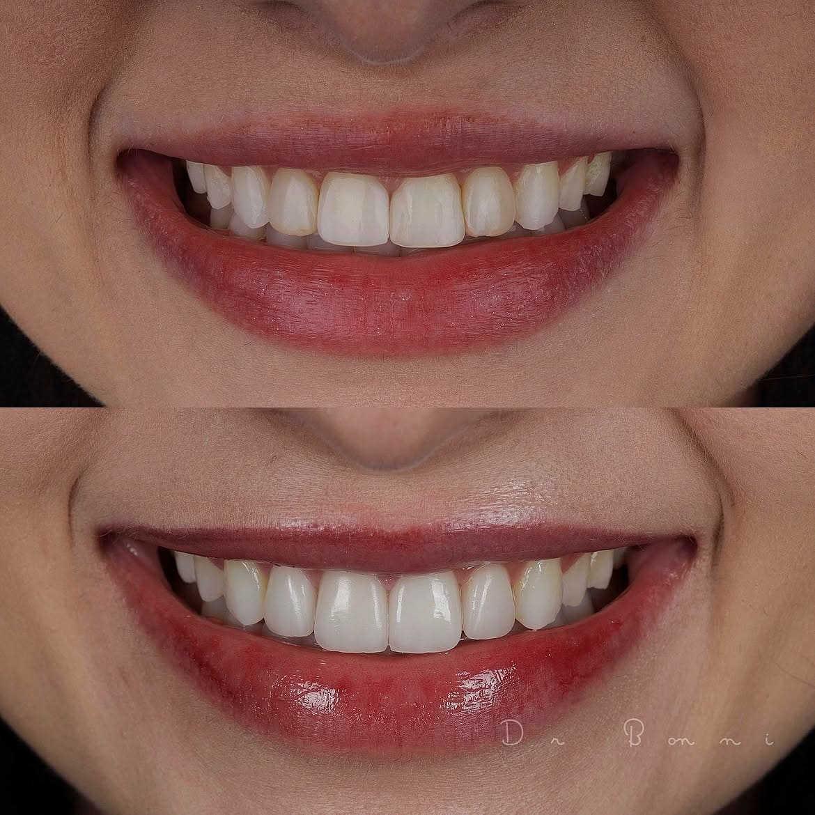 Dental Veneer Before and after