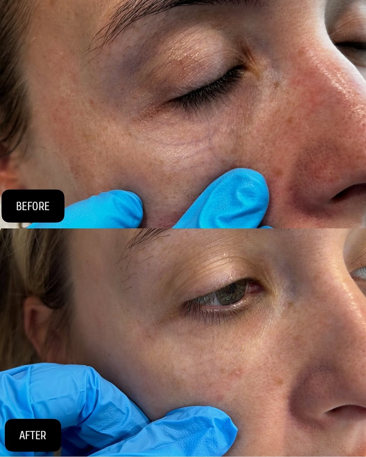 Treatment of periocular veins with laser, our Clear V treatment.❇️May require multiple sessio