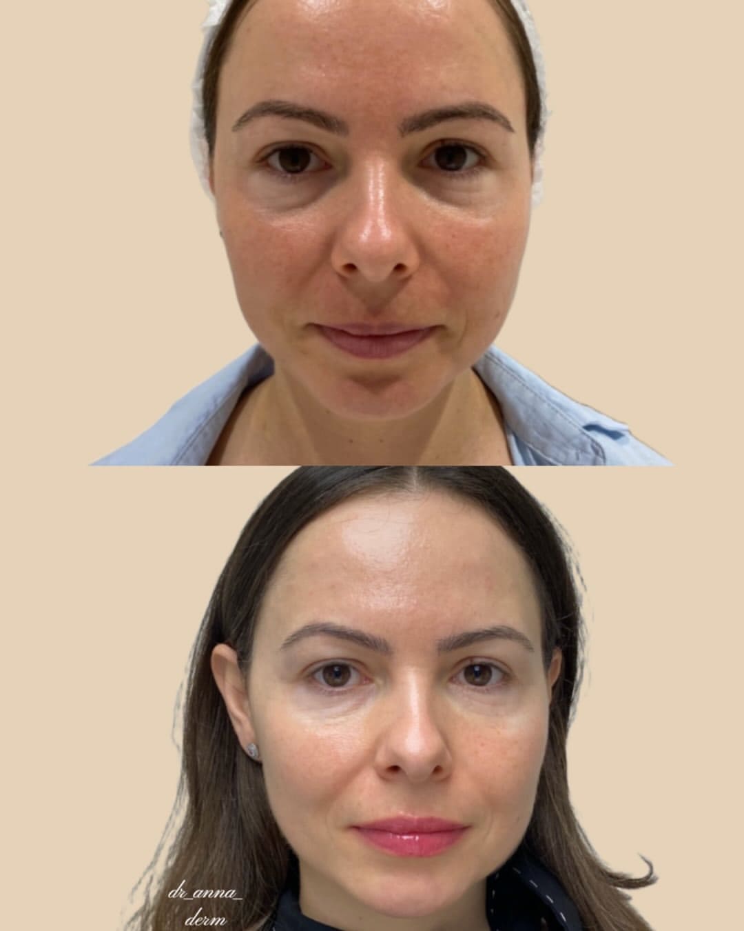 Ultherapy – Lower-Face Lifting HA Fillers – Facial Contouring Botulinum Toxin – Facial Relaxation & Lifting