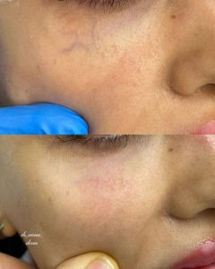 Periorbital Veins Removal with LaserSay goodbye to visible under-eye veins with a quick, safe