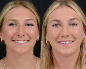 Rhinoplasty & Chin Implant
