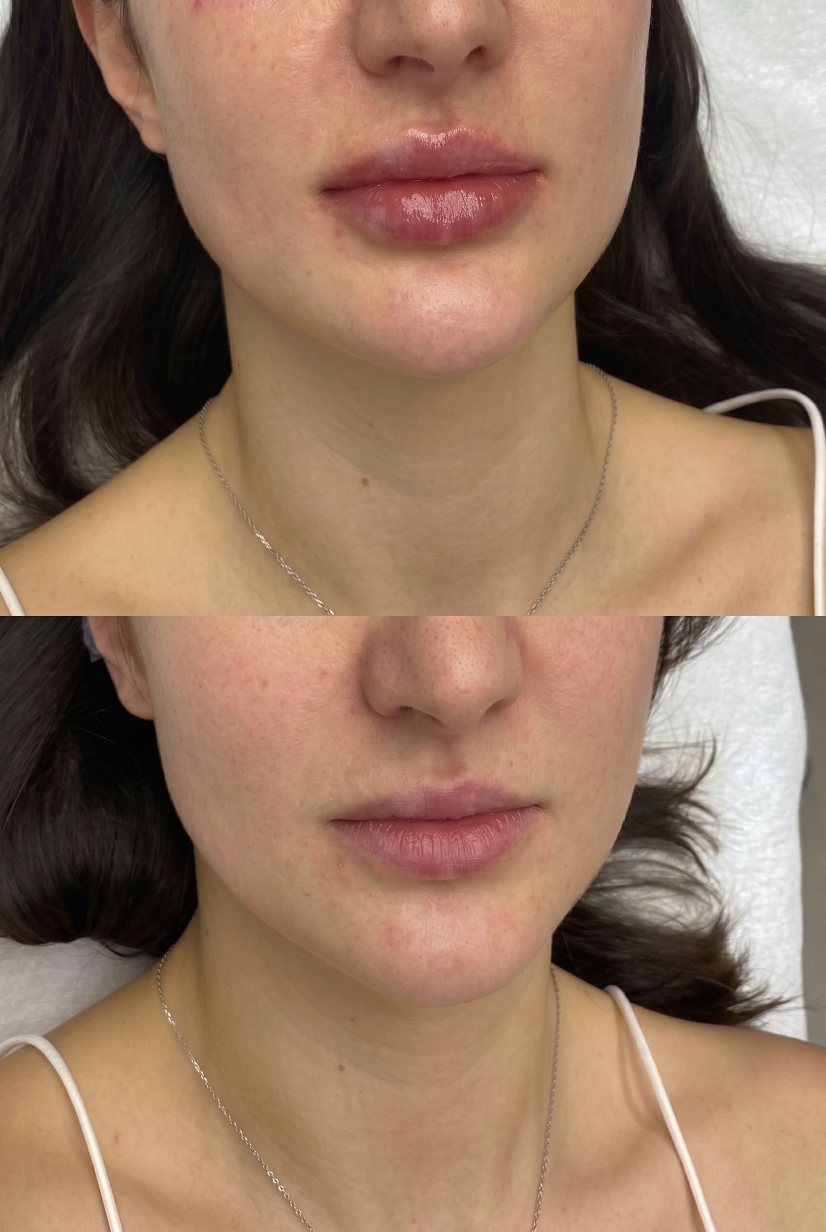 Lip Fillers