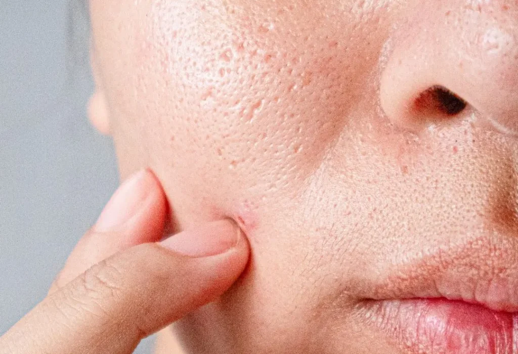 Close-up of skin with large pores