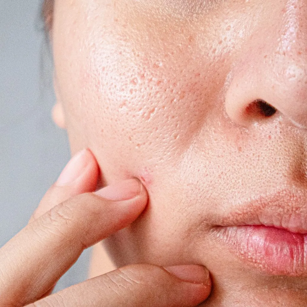 Close-up of skin with large pores