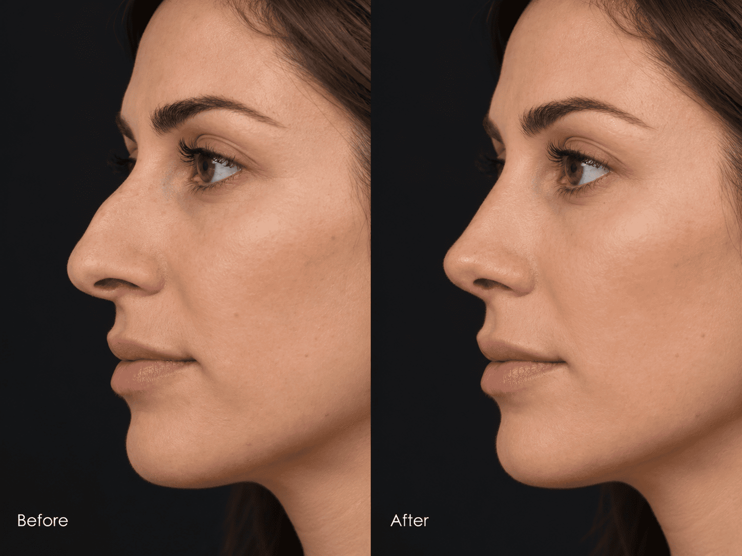 Septoplasty Surgery in Dubai